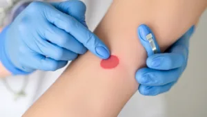 常見的傷口感染預防