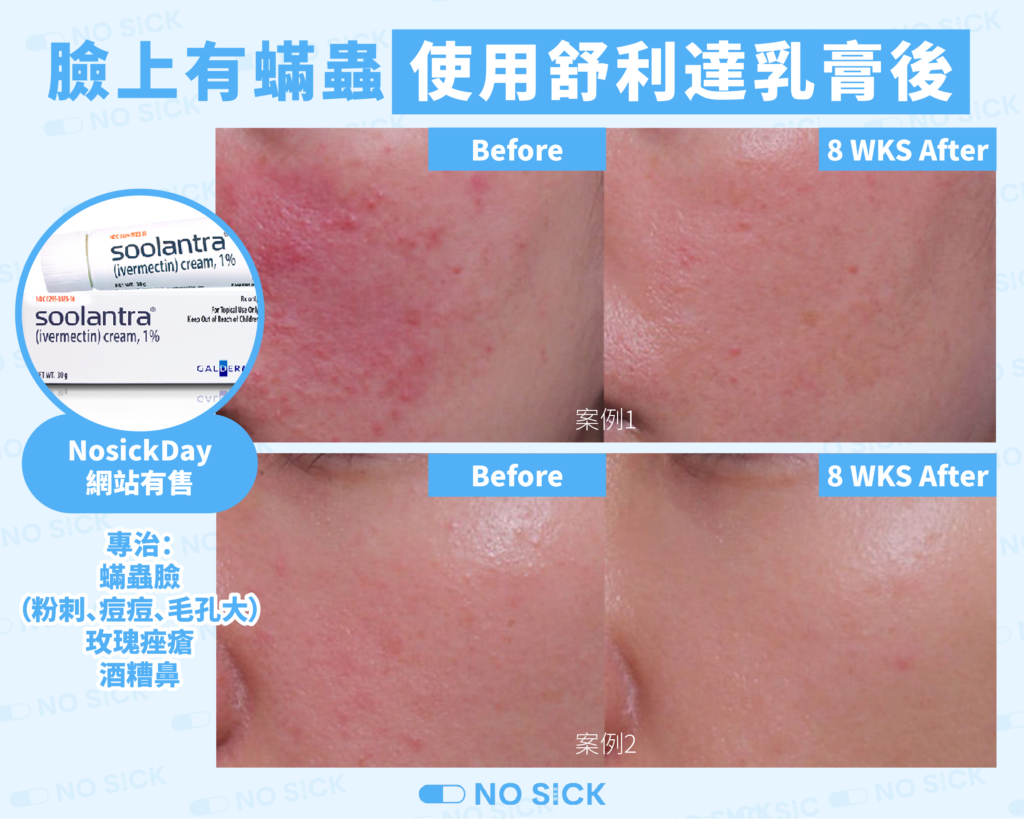 Nosickday舒利達乳膏-蟎蟲臉治療